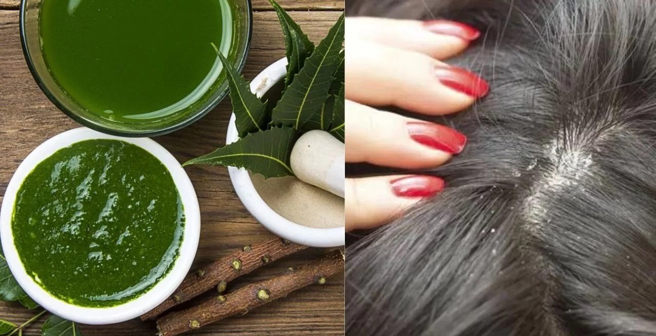 Best Dandruff Treatment That Will Cure Your Inner Health Of Hair